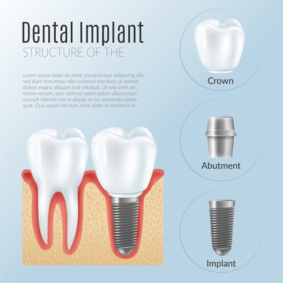 Structure of dental prosthetics infographics poster with denture near healthy tooth crown abutment implant realistic icons vector illustration