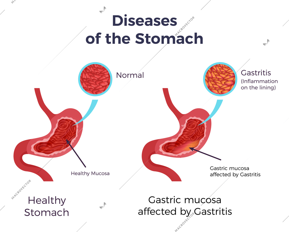 Human normal stomach compared to gastritis affected swollen inflamed mucosa lining flat set infographic poster vector illustration