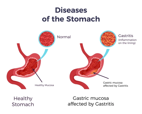 Human normal stomach compared to gastritis affected swollen inflamed mucosa lining flat set infographic poster vector illustration