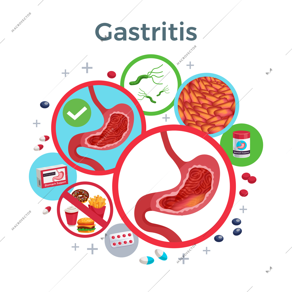 Gastritis disease symptoms causes medicine flat circular composition of healthy and affected stomach bacteria food vector illustration