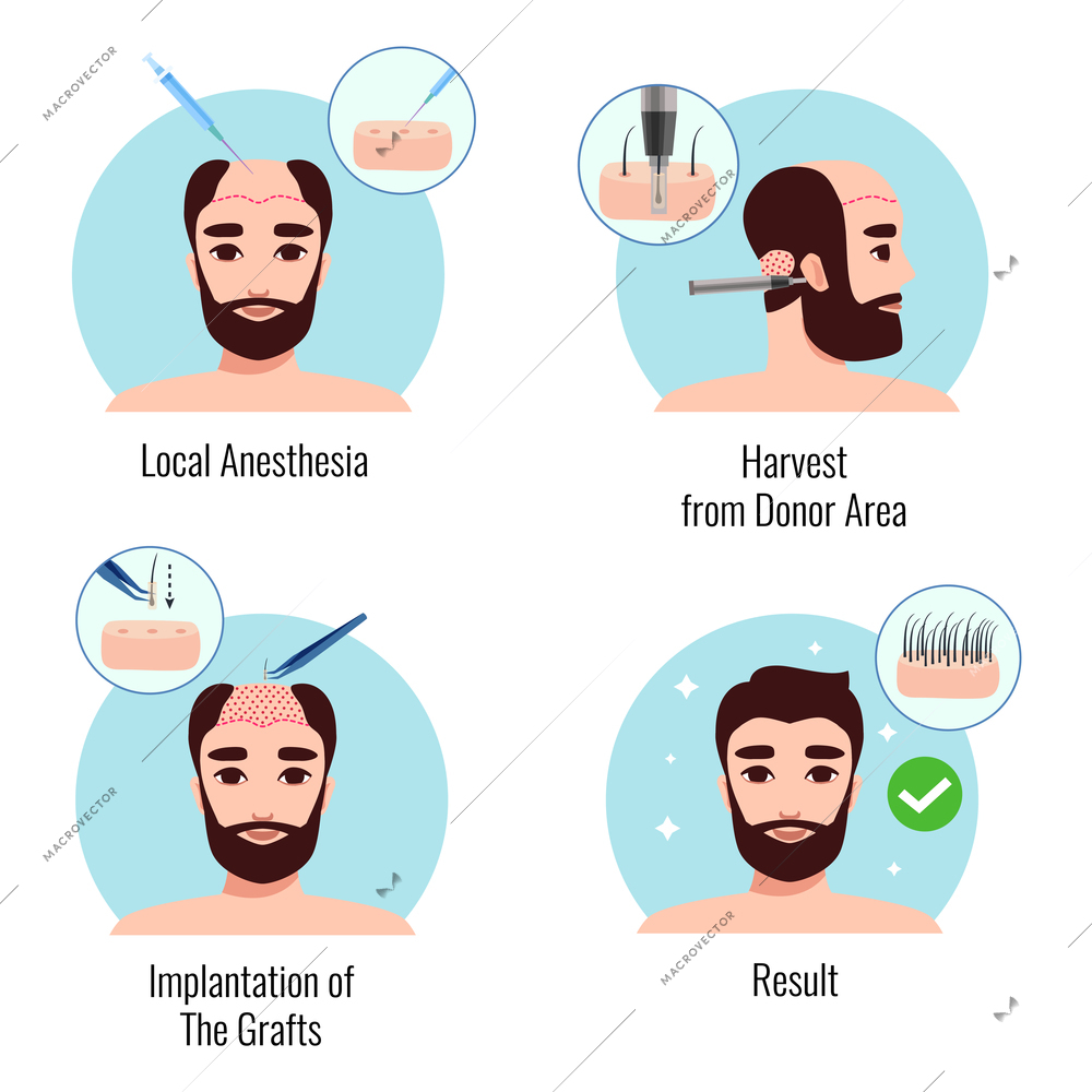 Design concept with bearded man on stages of hair transplantation procedure isolated vector illustration