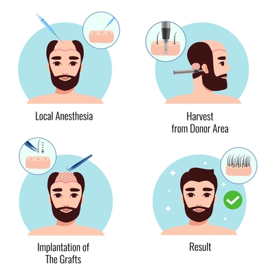 Design concept with bearded man on stages of hair transplantation procedure isolated vector illustration