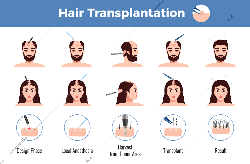 Hair transplantation for men and women with stages of operation infographics on white background vector illustration