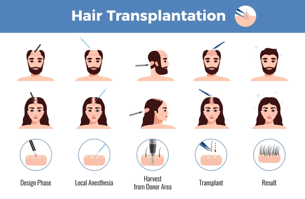 Hair transplantation for men and women with stages of operation infographics on white background vector illustration