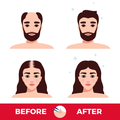 Man and woman before and after hair transplantation on white background flat vector illustration