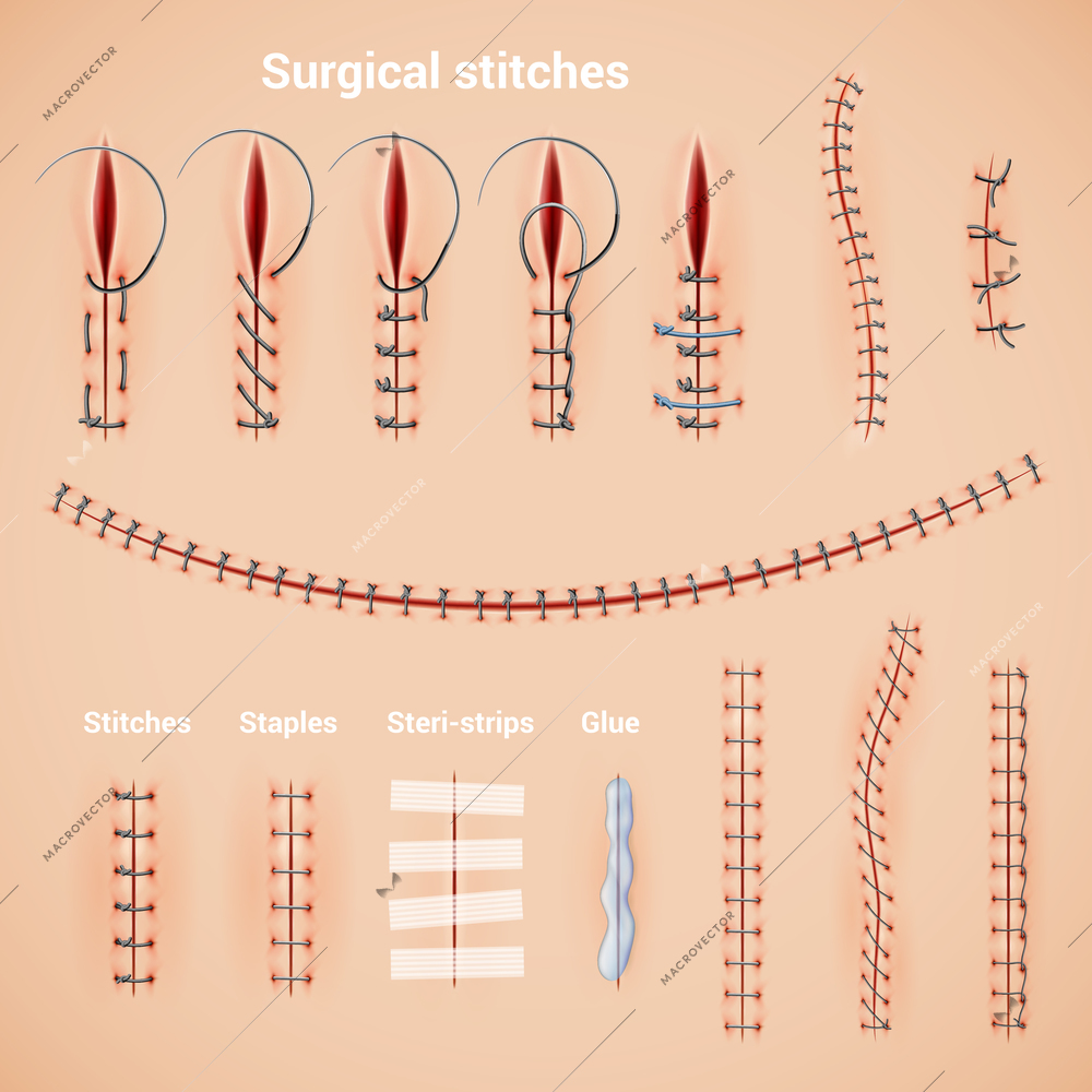 Surgical suture stitches realistic set of stitching methods and shapes with staples glue and text captions vector illustration