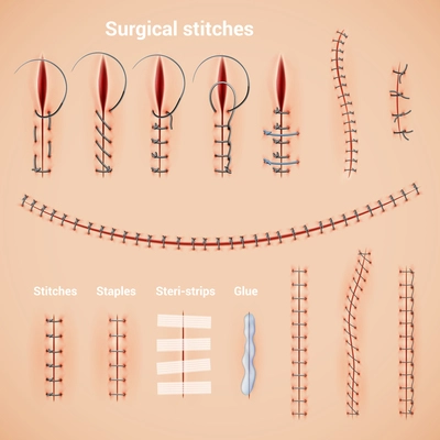 Surgical suture stitches realistic set of stitching methods and shapes with staples glue and text captions vector illustration