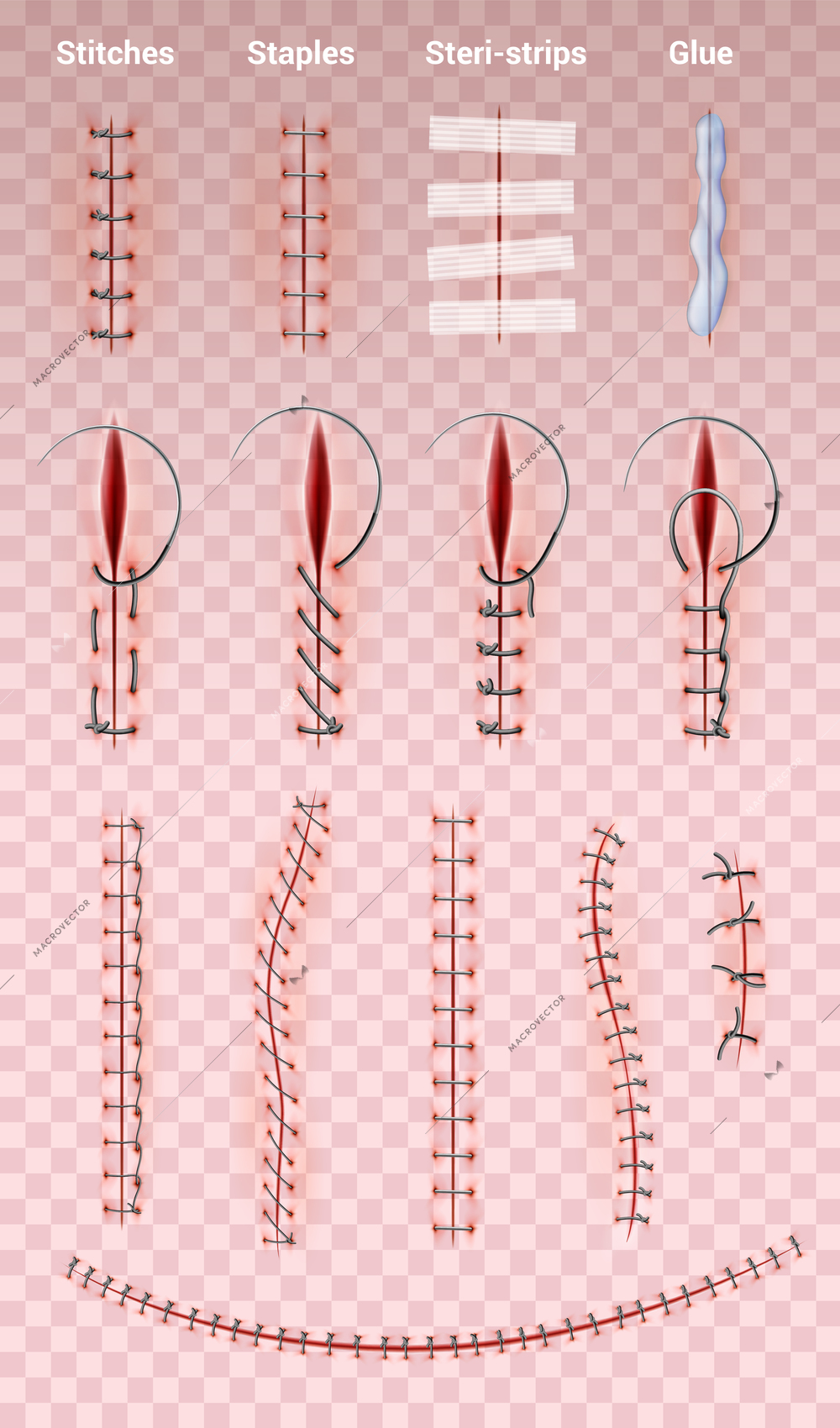 Surgical suture stitches realistic set of images on transparent background with different shapes of medical stitching vector illustration
