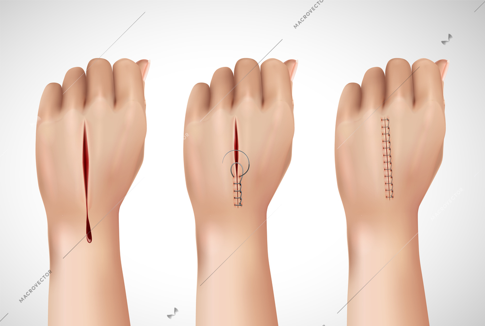 Surgical suture stitches realistic composition with isolated images of human hand at different stages of stitching vector illustration