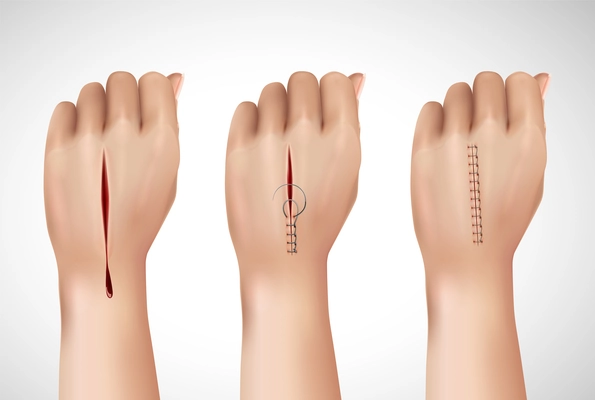 Surgical suture stitches realistic composition with isolated images of human hand at different stages of stitching vector illustration