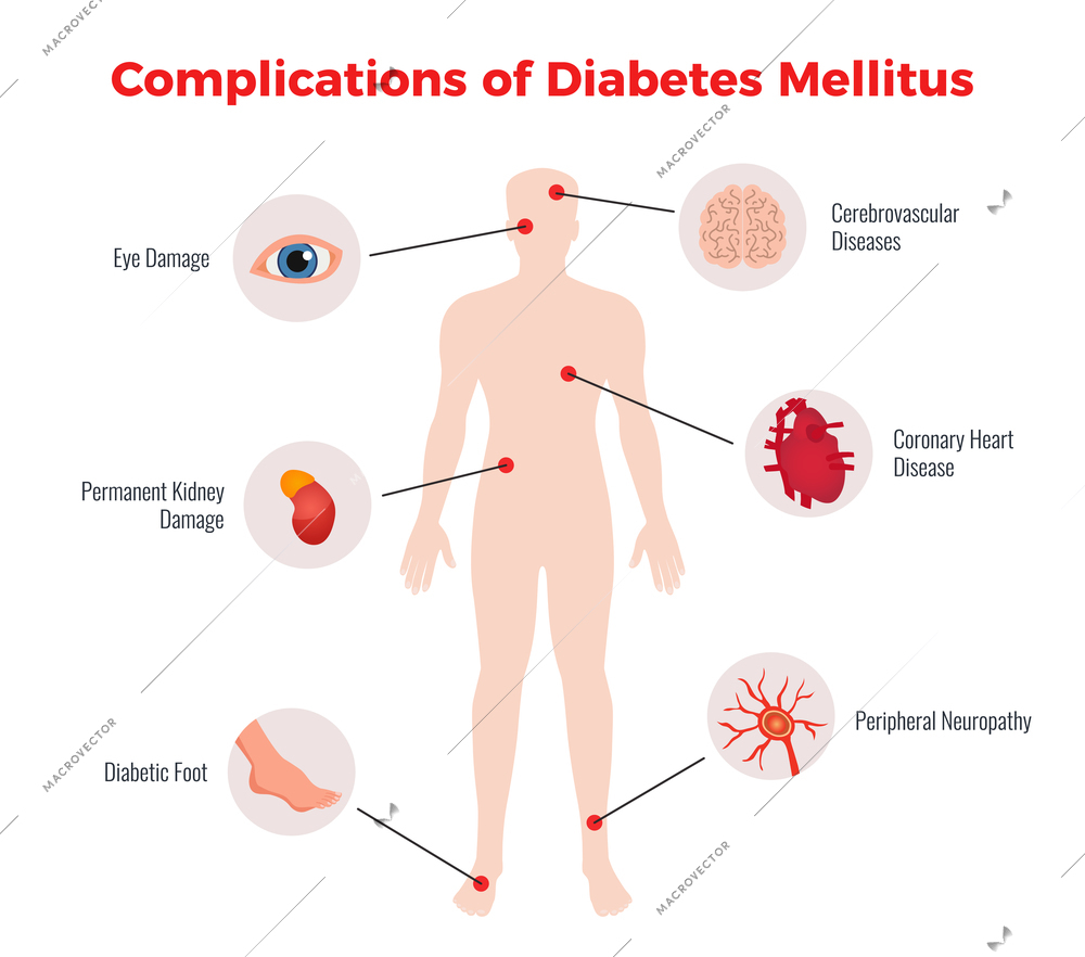 Diabetes complications medical educational chart poster with affected human organs damages depiction and description flat vector illustration