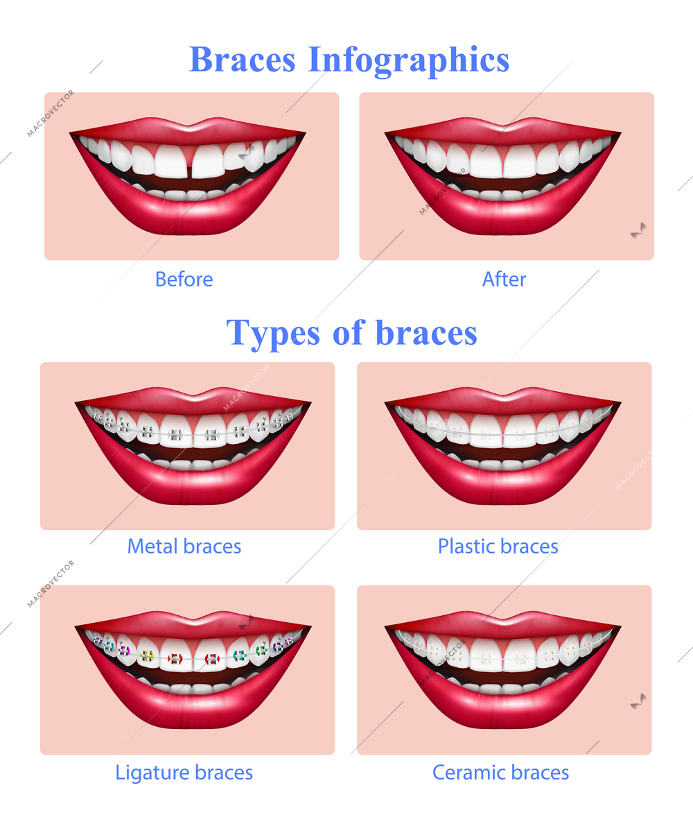 Opened mouth with red glossy lips showing  metal plastic ceramic teeth braces types realistic infographic vector illustration