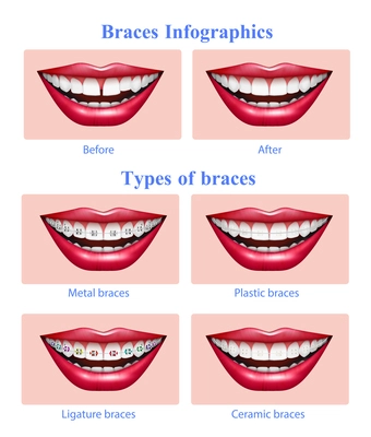 Opened mouth with red glossy lips showing  metal plastic ceramic teeth braces types realistic infographic vector illustration