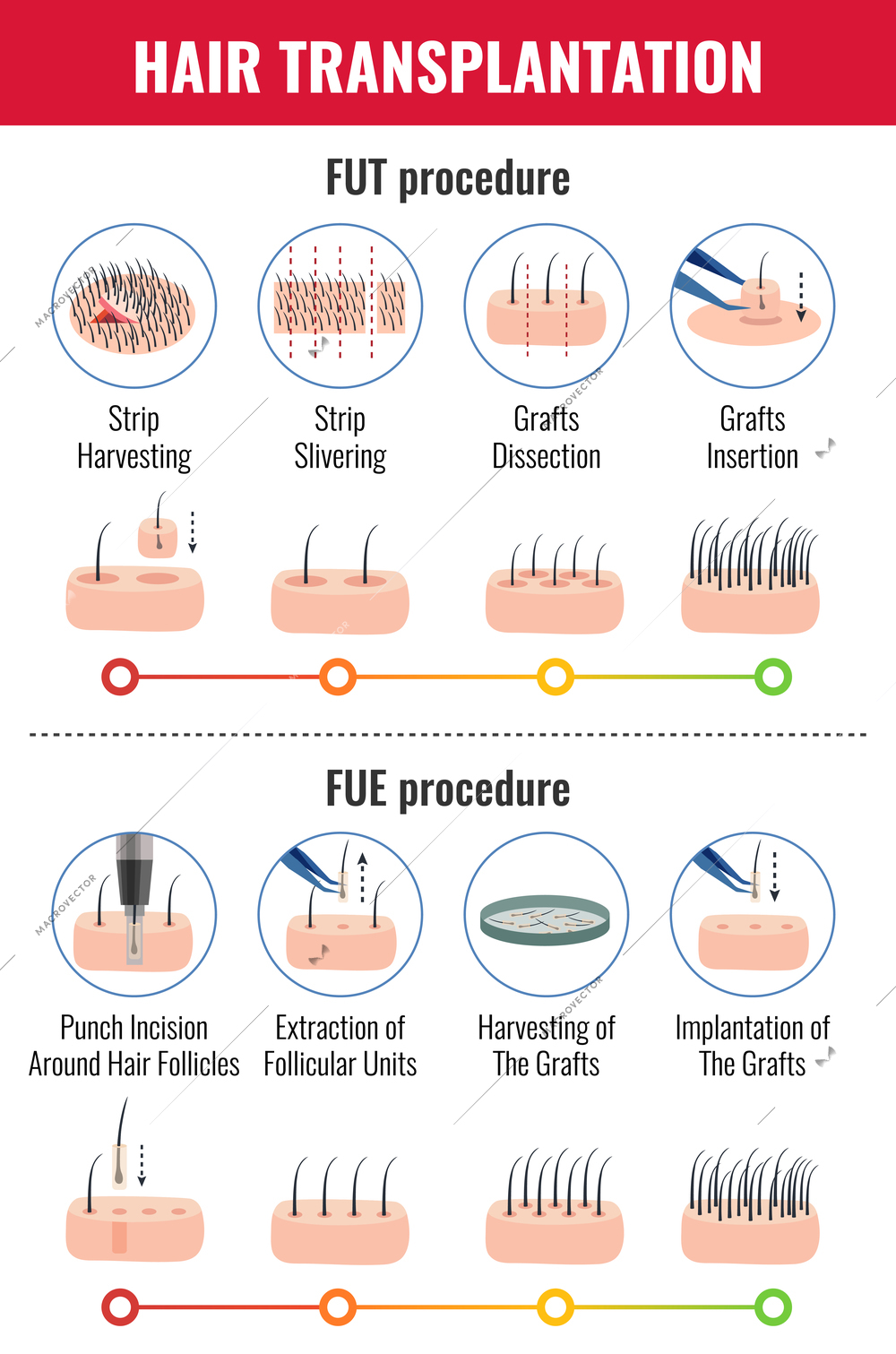 Methods of hair transplantation with stages of procedure infographics on white background vector illustration