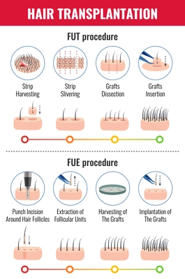 Methods of hair transplantation with stages of procedure infographics on white background vector illustration