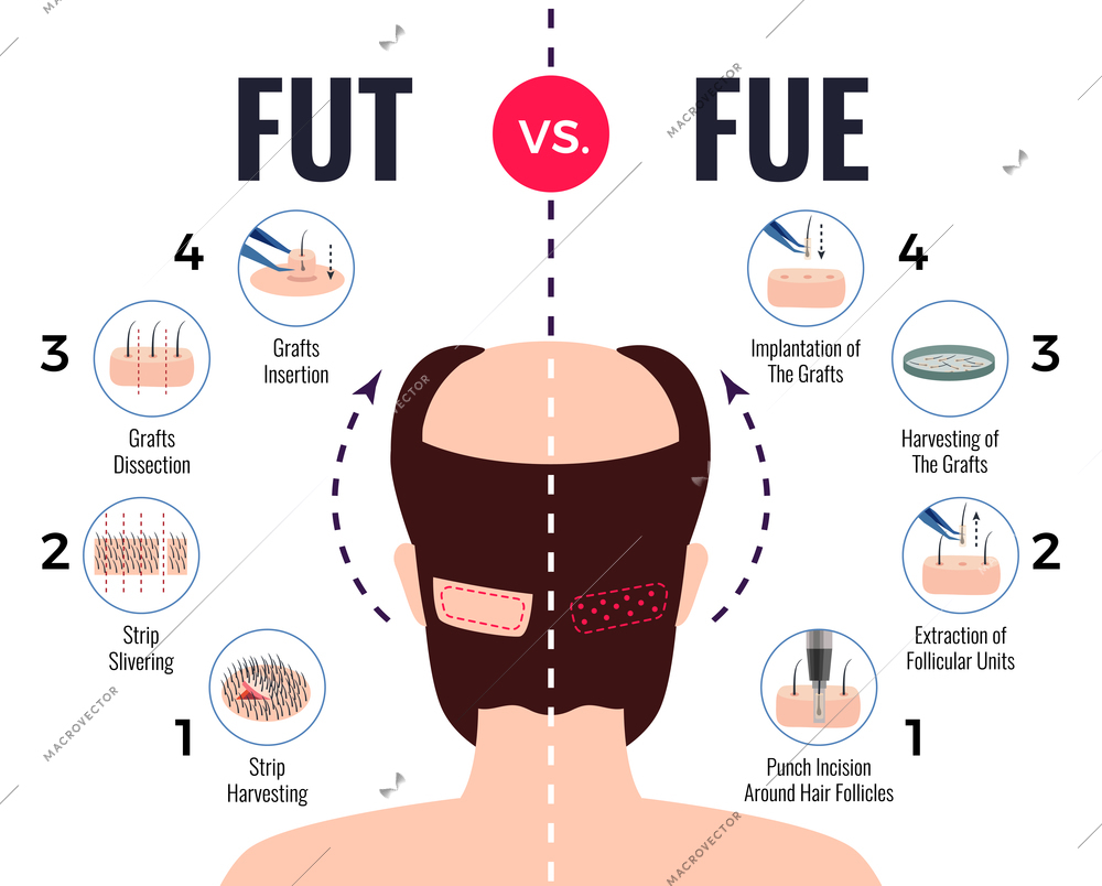 Methods of hair transplantation fut vs fue poster with infographic elements on white background vector illustration