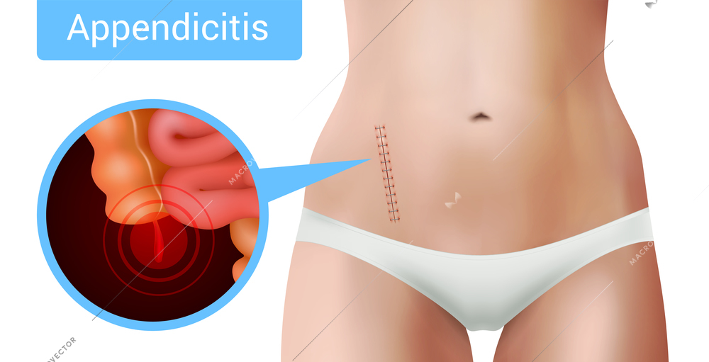 Surgical suture stitches realistic appendicitis composition with view of surgical intervention mark on realistic female body vector illustration