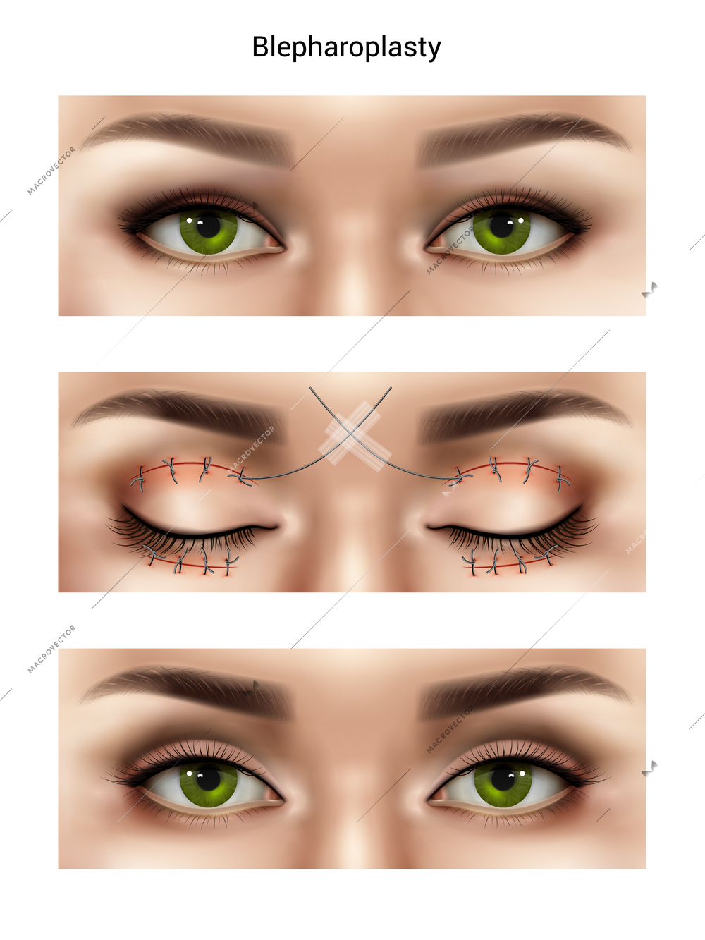 Surgical suture stitches realistic composition with images of female eyes at different stages of blepharoplasty procedures vector illustration