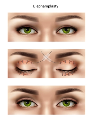 Surgical suture stitches realistic composition with images of female eyes at different stages of blepharoplasty procedures vector illustration