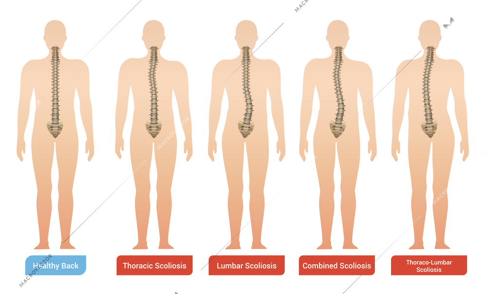 Spinal curvature scoliosis medical infographic images set with silhouettes of human body with spine and text vector illustration