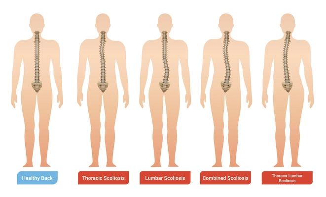 Spinal curvature scoliosis medical infographic images set with silhouettes of human body with spine and text vector illustration