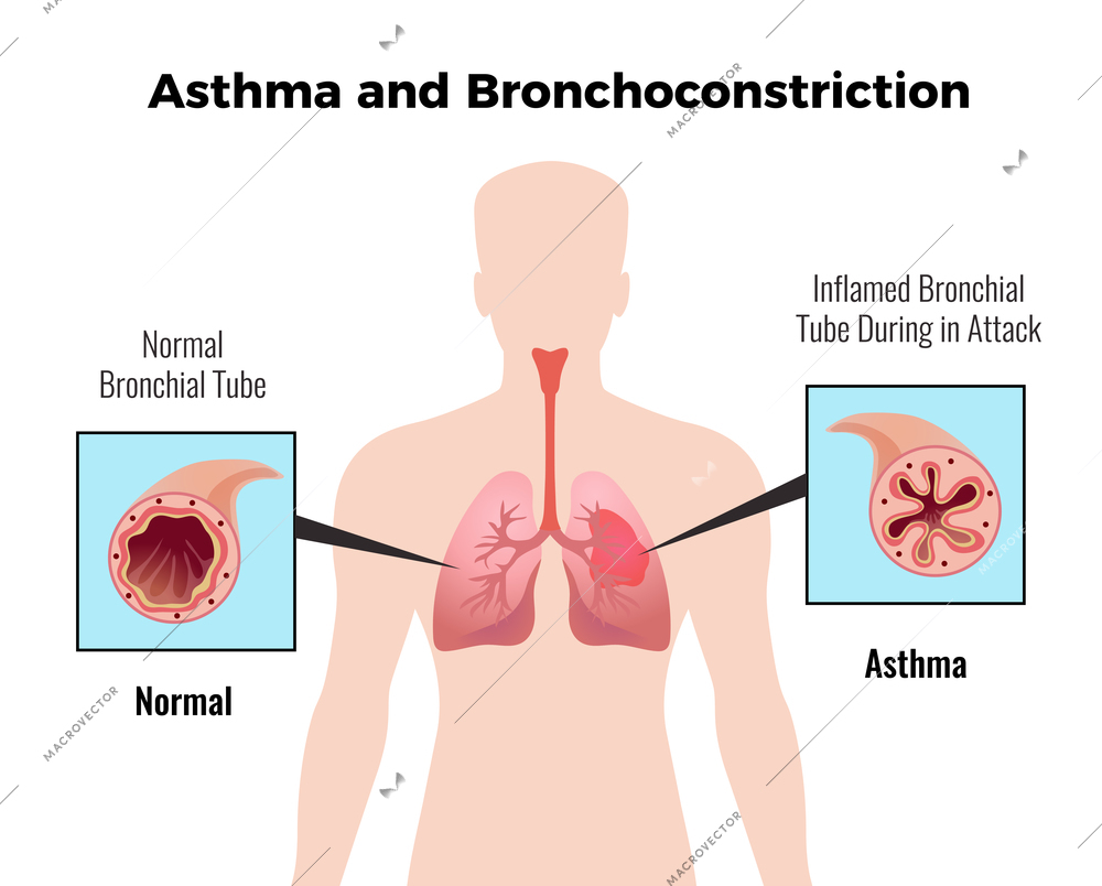 Asthma attack medical educative chart poster with depiction of normal and inflamed bronchial tube flat vector illustration