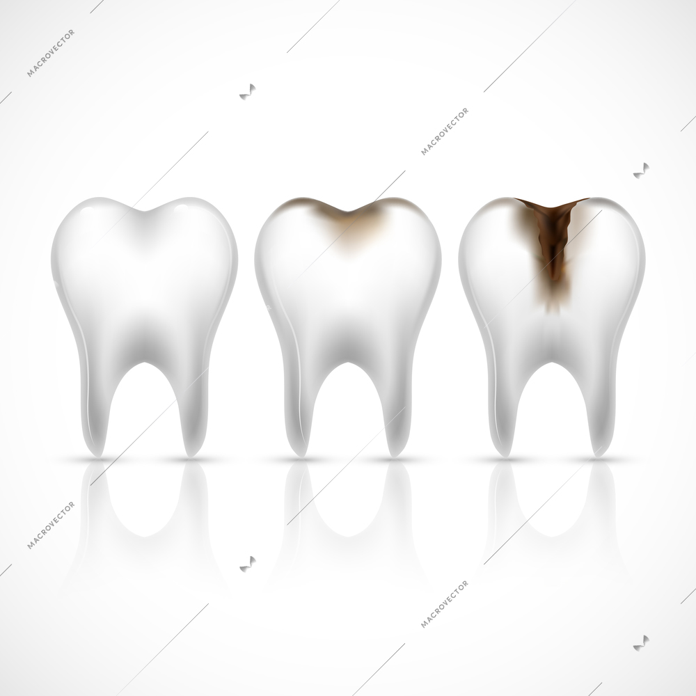 Realistic white and caries broken teeth set vector illustration