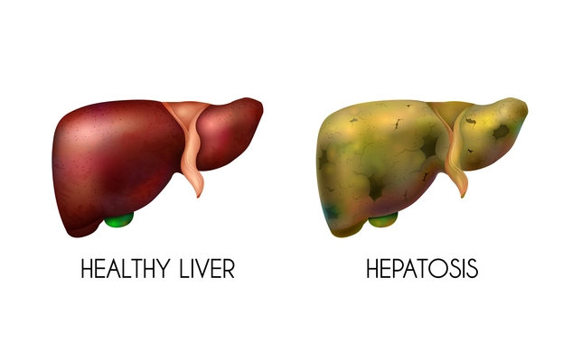 Realistic human internal organs liver healthy normal unhealthy fatty composition with two different colors when the disease is present vector illustration