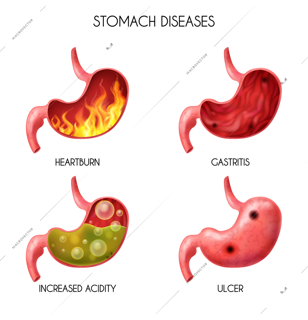 Realistic human internal organ stomach icon set pyrosis fire disorder gastric acid reflux abdominal bloated ball nausea vector illustration