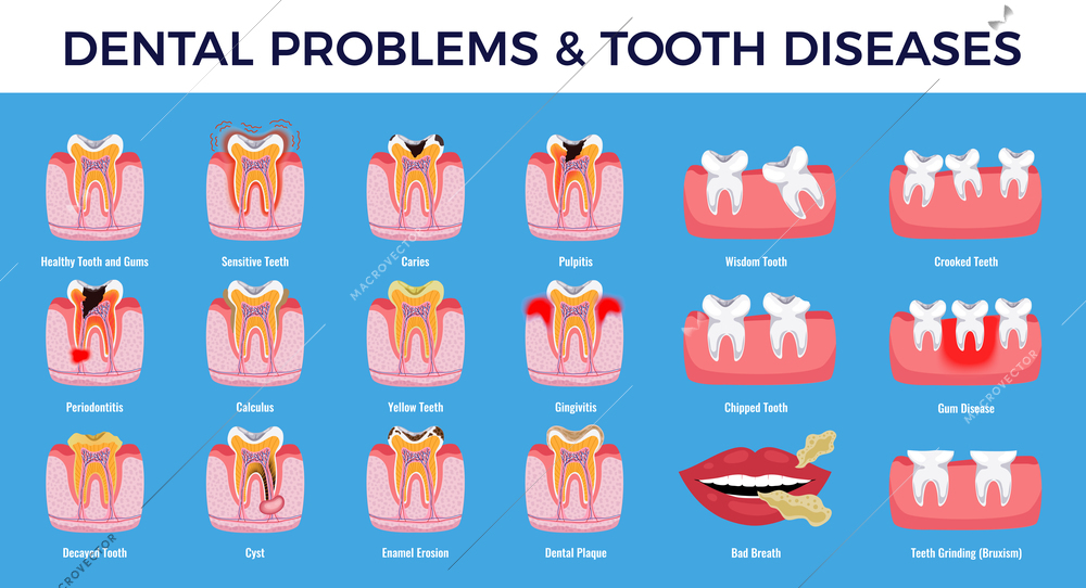 Dental problems educational infographic info chart set with  caries pulpit inflammation tooth plaque enamel erosion vector illustration