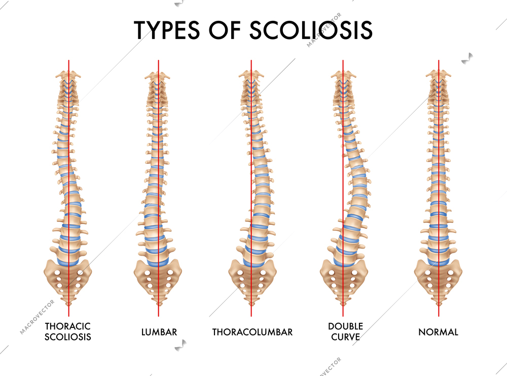 Human spine anatomy scoliosis types set with normal and 3 pathological images realistic medical chart vector illustration