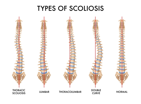 Human spine anatomy scoliosis types set with normal and 3 pathological images realistic medical chart vector illustration