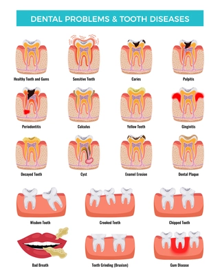 Dental oral problems educational infographic set with caries inflammation tooth plaque bad breath enamel erosion vector illustration