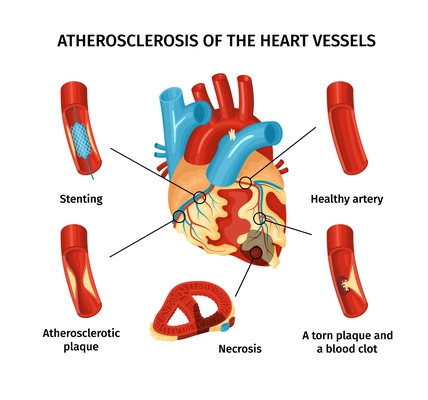 Atherosclerosis of heart vessels flat infographics with labeled parts vector illustration