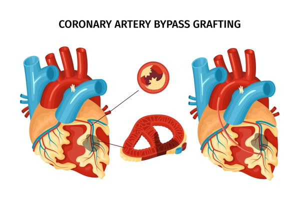 Anatomy of heart with coronary artery bypass grafting flat vector illustration