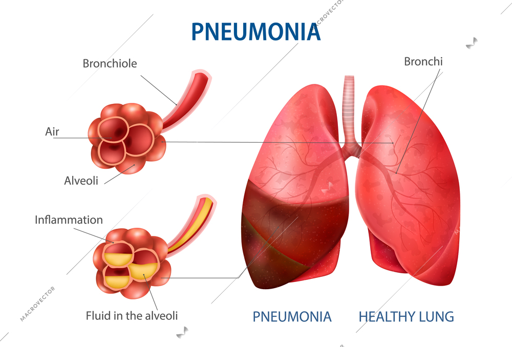 Pneumonia realistic set with healthy lung symbols vector illustration