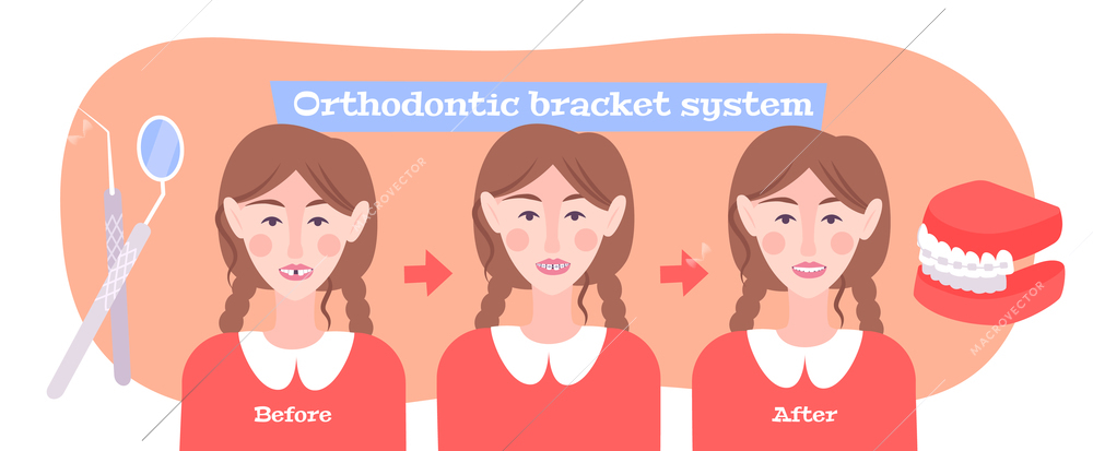 Braces on teeth flat flowchart composition with female characters of patient before and after correction procedure vector illustration