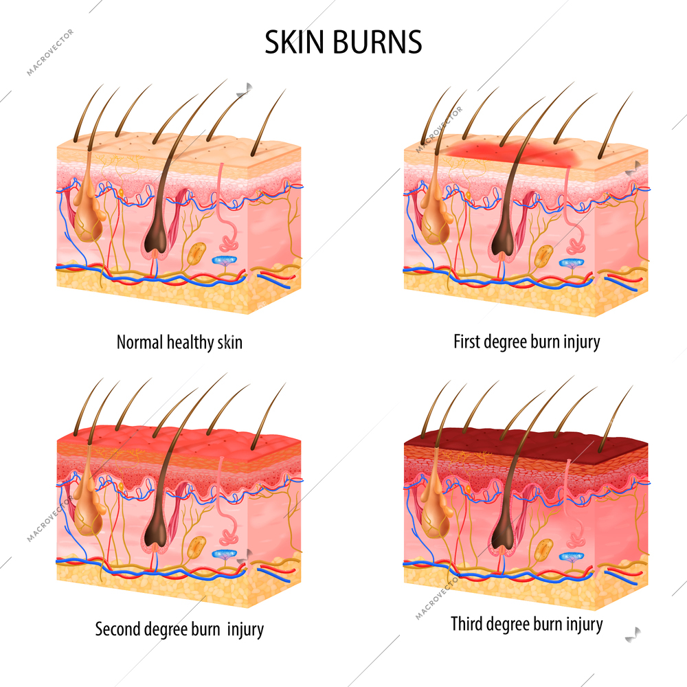 Realistic set of normal and three degree of burns skin structure isolated on white background vector illustration