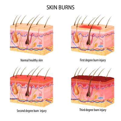 Realistic set of normal and three degree of burns skin structure isolated on white background vector illustration