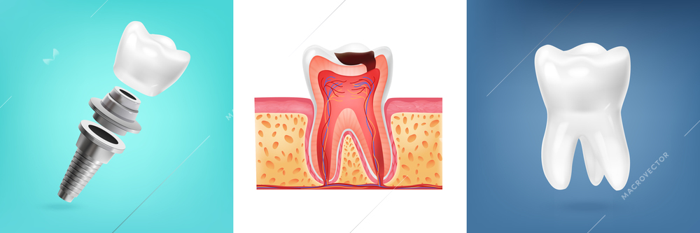 Realistic design concept with human tooth anatomy and dental post isolated vector illustration