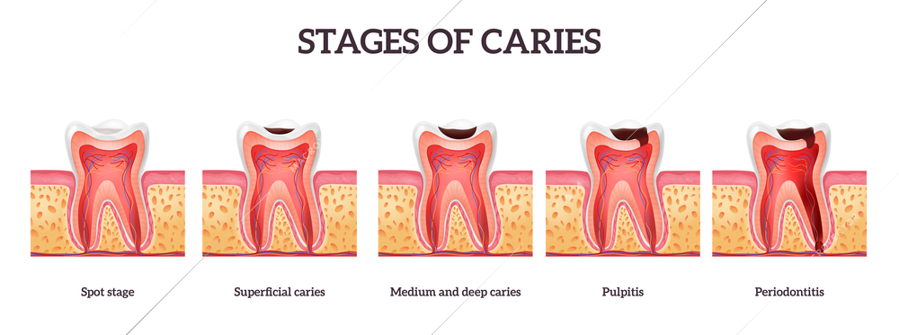 Stages of caries and tooth destruction from spot to periodontitis realistic isolated vector illustration