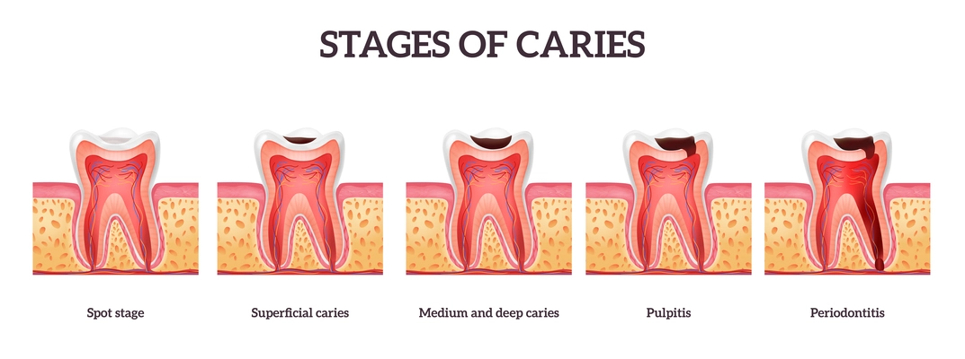 Stages of caries and tooth destruction from spot to periodontitis realistic isolated vector illustration