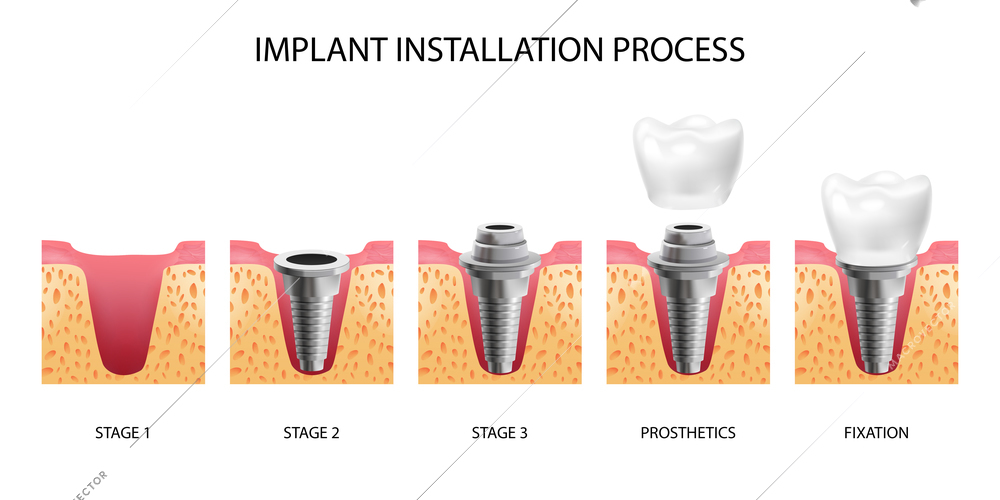 Five stages of dental implant installation realistic isolated vector illustration