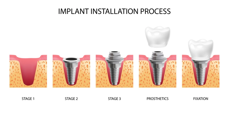 Five stages of dental implant installation realistic isolated vector illustration