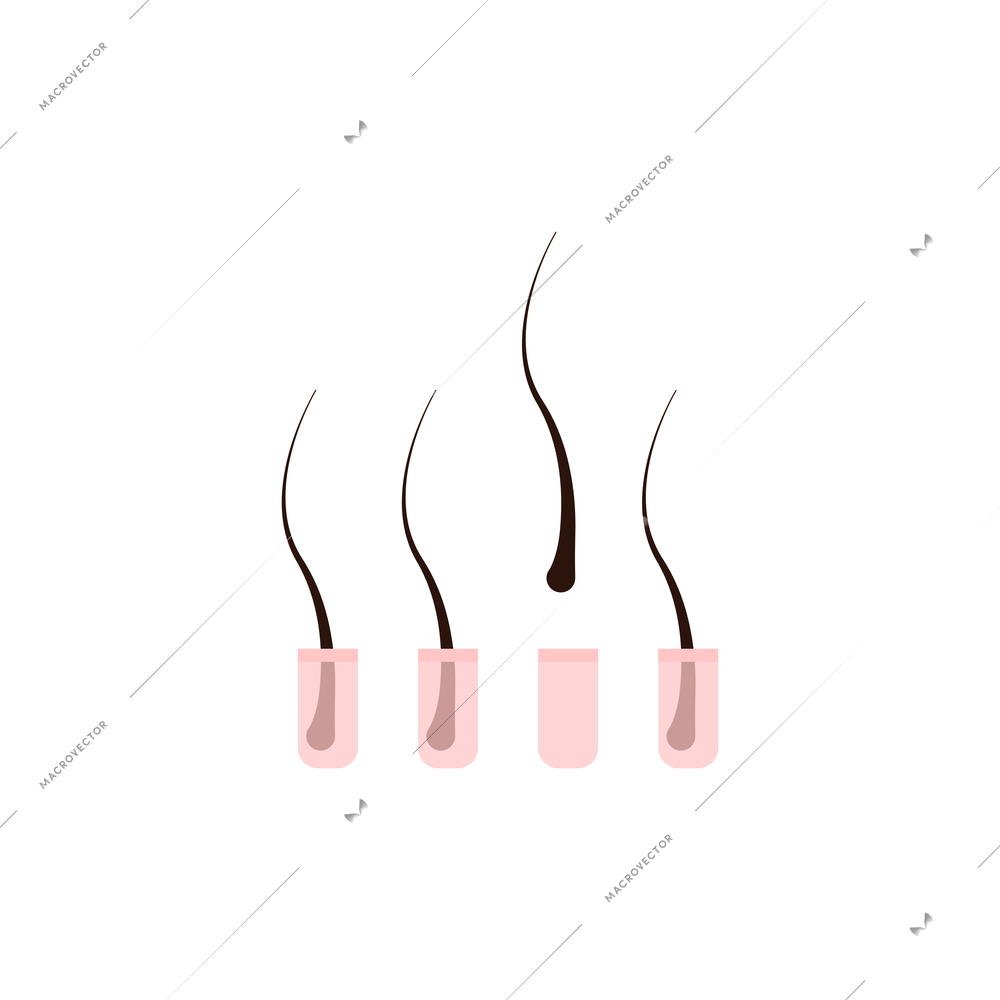 Hair loss alopecia flat design concept isolated on white background vector illustration