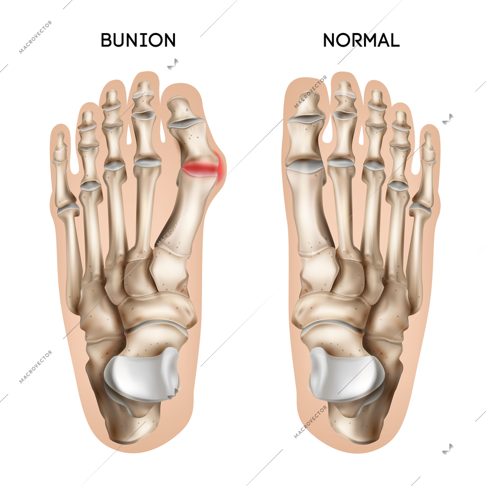 Realistic bunion foot composition with editable text captions and views of normal and damaged human footsteps vector illustration