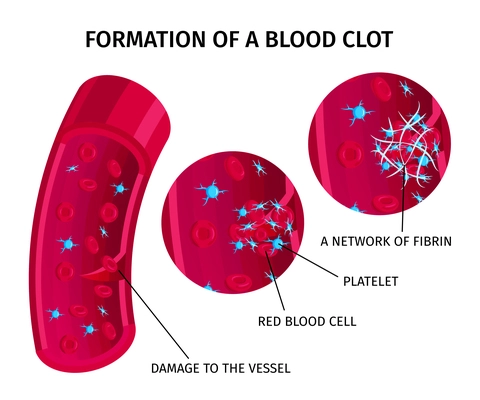 Blood cells thrombus coagulation educative infographic colorful chart depicting clot formation process vector illustration