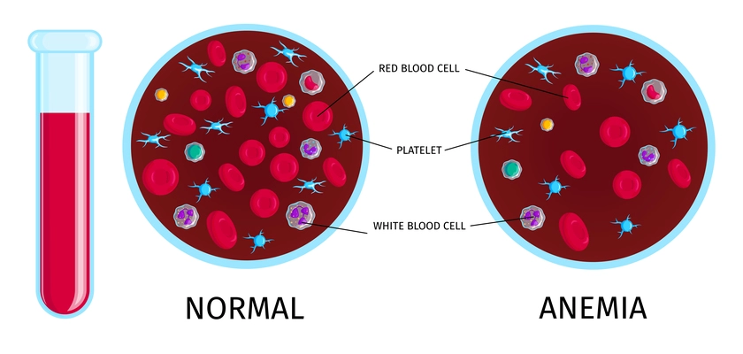 Anemia colorful educative info chart with test tube normal and low number red blood cells samples vector illustration