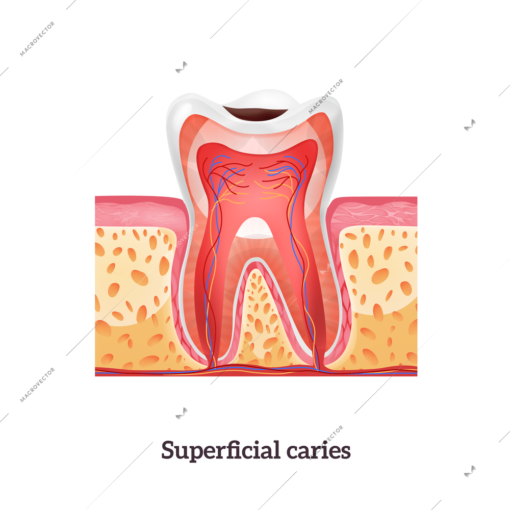 Tooth anatomy with superficial caries realistic vector illustration