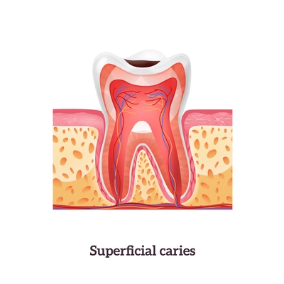 Tooth anatomy with superficial caries realistic vector illustration